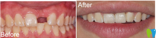 洛陽(yáng)澗西維樂(lè)口腔案例