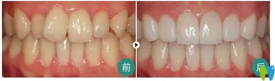 費麗敏主任牙齒不齊矯正案例