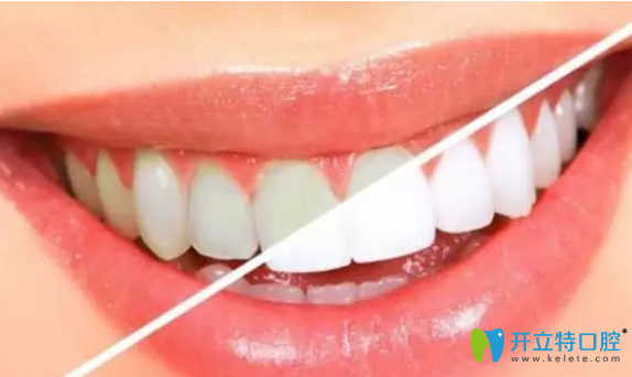 咸陽三秦牙齒美白效果