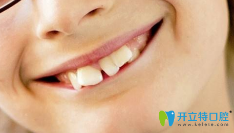 孩子牙齒不好哪個年齡段整牙好？3M隱形牙套還你整齊牙齒