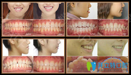 廣州瑞爾齒科中石化診所牙齒矯正案例圖