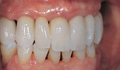 80歲老人選擇在廈門(mén)登特口腔做種植牙，是因?yàn)閮r(jià)格實(shí)惠