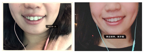 滁州德仁隱形牙齒矯正1年后讓我的牙齒悄無聲息變整齊