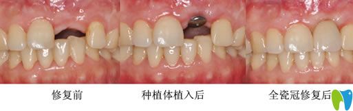 長(zhǎng)春晟諾口腔唐永旺院長(zhǎng)種植牙案例