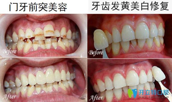 惠州致美口腔馬文智牙齒美學(xué)修復(fù)案例