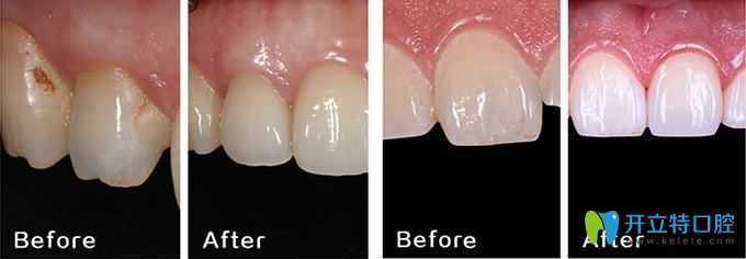 長(zhǎng)春晟諾口腔牙齒修復(fù)案例
