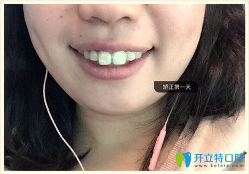 帶上隱形牙套天