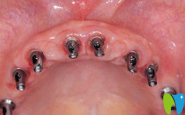 登特口腔種植牙術(shù)中