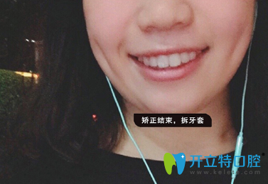 經過1年1個月時間牙齒矯正整齊