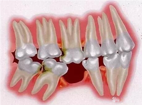 牙齒缺失了 這有三種修復(fù)手段哪種會比較好？