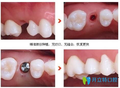 宿遷大眾口腔微創(chuàng)種植牙 安心種植新選擇！