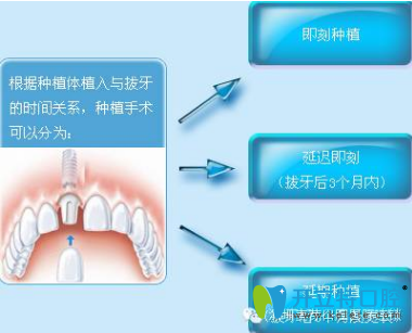 微創(chuàng)種植