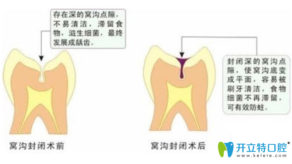 九江奇洋口腔醫(yī)生科普：兒童做窩溝封閉前不得不看的問題