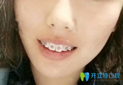 九江奇洋口腔牙齒正畸第1天照片