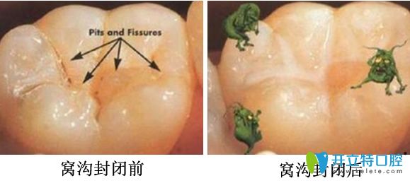 兒童做窩溝封閉前后對比圖