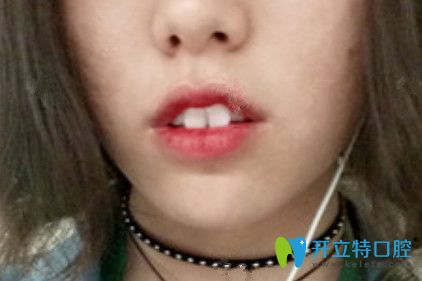 在九江奇洋口腔做了牙齒矯正，我擺脫了“兔牙妹”稱號