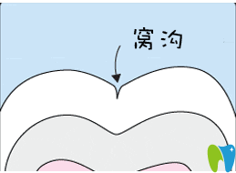 秦皇島口腔為6-9歲孩子免費進行窩溝封閉