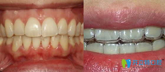 惠州致美口腔劉宏平做隱性矯正第110天效果圖 惠州致美口腔劉宏平做隱性矯正第110天效果圖