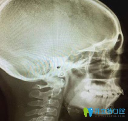 牙齒矯正術前拍片側面牙齒照片