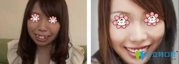 馬曉春院長(zhǎng)牙齒矯正案例