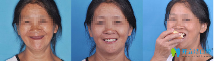 致美口腔種植案例--當(dāng)日即食