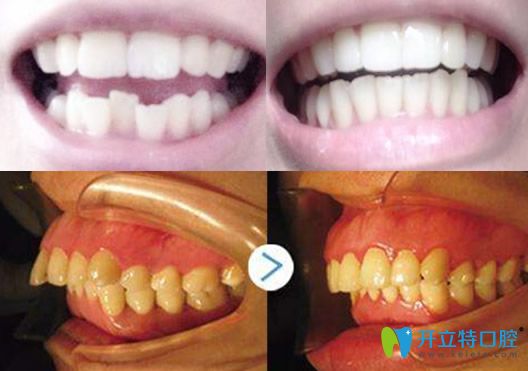 九江奇洋口腔馮蘭醫(yī)生牙齒矯正案例對比圖