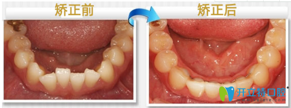 致美口腔隱形矯正案例 致美口腔隱形矯正案例