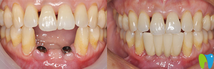 寧波拜博拜爾口腔吉東種植牙效果對比圖 寧波拜博拜爾口腔吉東種植牙效果對比圖