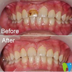 茂名致美牙齒修復(fù)案例