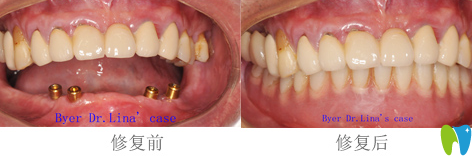 拜博拜爾口腔沙金賀醫(yī)生種植牙效果圖
