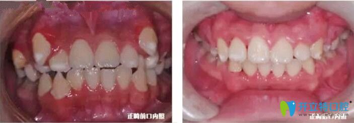 張學(xué)鵬主任牙齒正畸案例