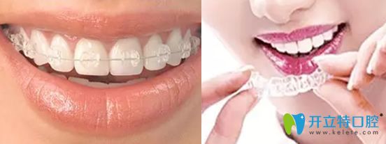 成人牙齒矯正選擇的方法圖