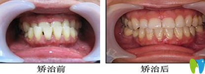 寧波拜博拜爾牙齒畸形矯正效果圖
