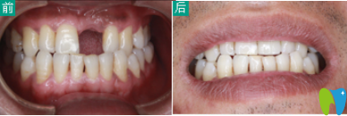 石家莊三博口腔種植牙案例