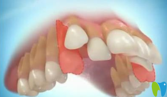 兒童在什么情況下矯正牙齒需要拔牙？拔牙矯正后會(huì)變松嗎