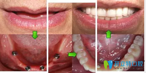 鎮(zhèn)江拜博口腔萬書健All-on-4種植牙種植過程圖