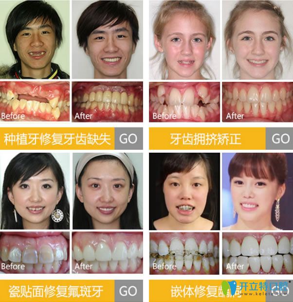 呼市亞非口腔治療真人案例 呼市亞非口腔治療真人案例