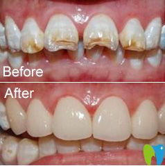 茂名致美牙齒缺損真人案例