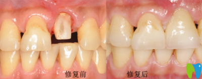 寧波拜博拜爾口腔林玉貴前牙美學修復效果圖