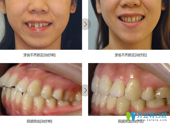 鎮(zhèn)江拜博口腔牙齒矯正前后對(duì)比照片