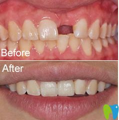 致美單顆牙齒缺失真人案例