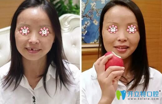 趙寶紅種植牙案例