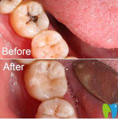 茂名致美補(bǔ)牙真人案例