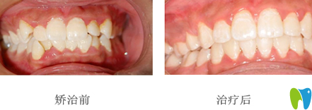 拜博拜爾口腔周茂棟院長牙齒正畸效果對比圖