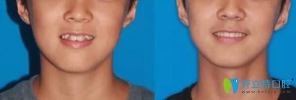 宋雪梅主任牙齒矯正案例