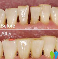 茂名致美牙周松動(dòng)案例