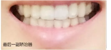 給大家看我在西安拜博口腔做的牙齒矯正日記，我在努力