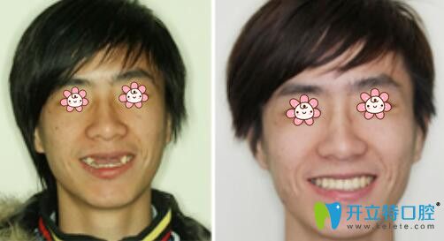 亞歷克斯副院長牙齒種植案例