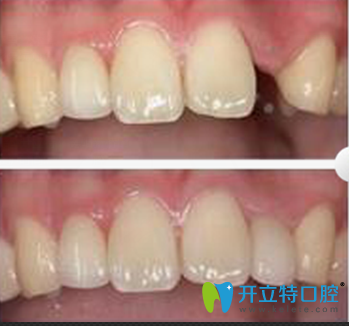 德陽(yáng)新橋口腔種植牙案例