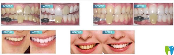 阜陽貝得口腔冷光美白牙齒案例 阜陽貝得口腔冷光美白牙齒案例